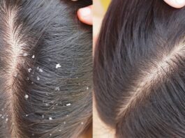 Remedies For Dandruff