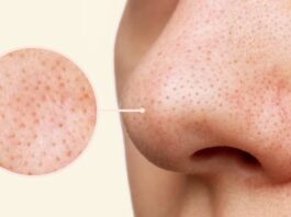 Remove Blackheads