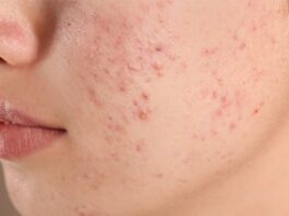 Side Effects Of Spicy Food On Skin