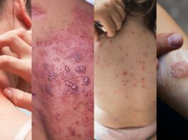 Kanpur : Skin disease patients increased by 20% due to changing weather, even a little carelessness can lead to death!