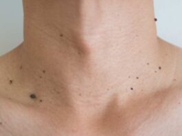 Warts in Body Cancer Sign