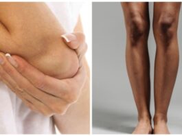 Home Remedies For Dark Elbows And Knees