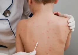 Remove Smallpox Stains