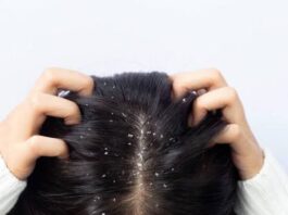 बार बार डैंड्रफ कर रहा है परेशान, तो इन कारणों को बिल्कुल भी ना करे नज़रअंदाज़
