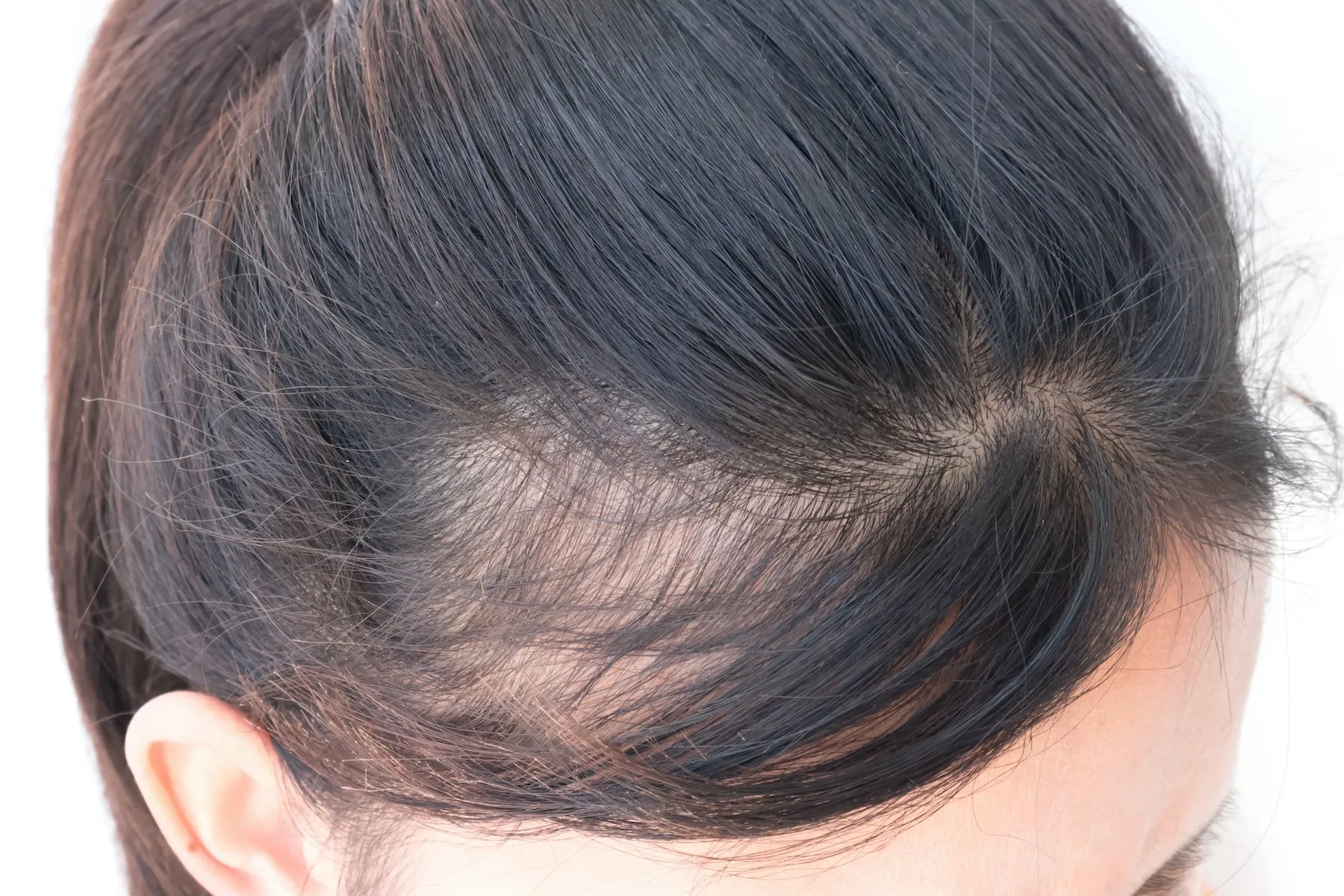 Hair Fall Due to Nutrient Deficiency