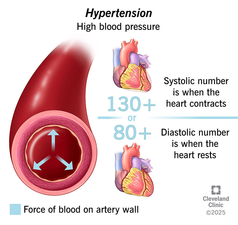 4314-high-blood-pressure-illustration