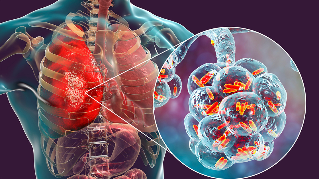 lung infection causes and symptoms
